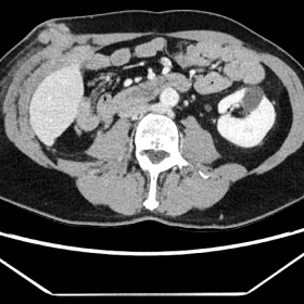Follow-up chest-abdomen-pelvis CT with intravenous contrast in portal venous phase in axial plane after radical right-sided nephrectomy showing local recurrence with focal retroperitoneal lesions, seeding along the liver and implantation in the abdominal wall on the right side