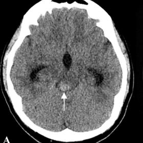 Computed tomography showing a hyperdense lesion in the dorsal midbrain