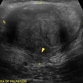 US findings of SMM. B-mode image (a) showing an iso-echoic rounded mass situated inside the biceps femoris muscle. Note the outpouching of the lesion towards the adjacent tissue (arrowhead)
