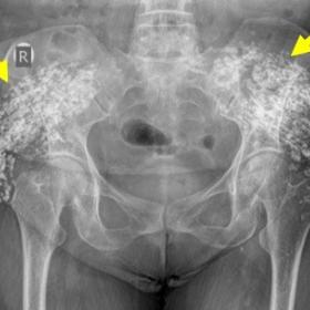 Antero – posterior radiograph of the pelvis showing bilateral clumped calcifications on gluteal regions (arrows)