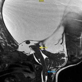 T2 weighted sagittal image of brain through midline shows narrowing of the CSF space at the level of the aqueduct(yellow arro