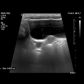 Ultrasound imagery of the right distal ureter with the distention measuring 9mm in diameter