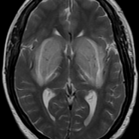 Axial T2WI and FLAIR showing bilateral swollen edematous basal ganglia, appearing as hyperintense lesions with 3 hyperintense