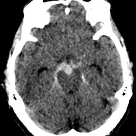 Noncontrast axial plane CT of the brain shows subarachnoid hemorrhage extending from the interpeduncular fossa to ambient cis