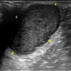 Ultrasound showed a superficial well-defined solid and heterogeneous mass, located in the right perineal region