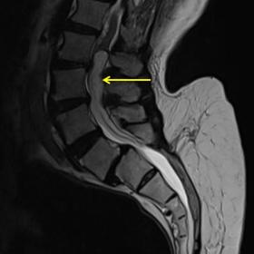 Sagittal T2 WI of lumbar spine shows an oval shaped intradural intradullary hyperintense lesion(yellow arrow) causing scallop