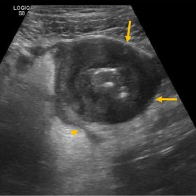 Ultrasound of the RLQ shows marked circumferential hypodense thickening of a bowel segment (arrows), with adjacent fat hyperecogenicity and a sliver of peritoneal fluid (arrowhead) 