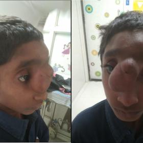 Clinical picture of the patient showing soft tissue swelling at the root of nose associated with mild hypertelorism