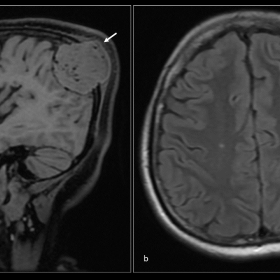 MRI demonstrates a T1 isointense and T2 hyperintense expansile intraosseous lesion (white arrow) involving the left parietal 