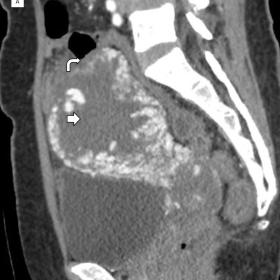 Image A shows a sagittal view demonstrating a hypodense mass in the uterus (small arrow) with a poor plane of differentiation