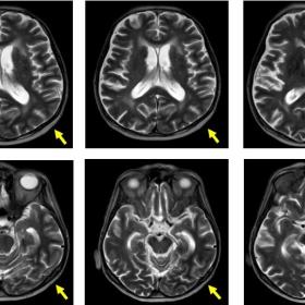 Axial T2 weighted images showing mild thickening and high intensity signal of the cortex of the left parieto-temporo–occipi