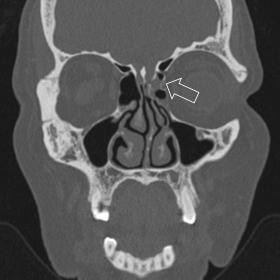 A coronal bone window noncontrast enhanced CT showing defect in left cribriform plate of ethmoid (white arrow)
