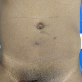 Clinical Picture – Ill-defined diffuse swelling on left inguinal region and left lumbar region