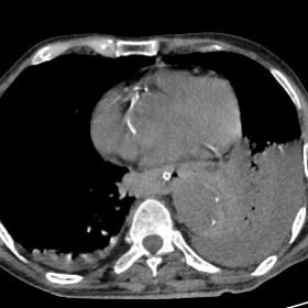 NCCT axial images of the thorax show crescentic hyperattenuating thoracic aortic wall thickening, signifying intramural hemat