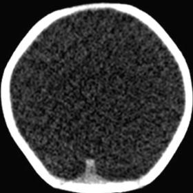 Axial plain CT head image of head at the level of frontal and parietal lobe. There is absence of bilateral frontal and parietal lobes, with CSF replacing them. The CSF is enclosed in a thin membrane-like structure. Midline falx is also absent