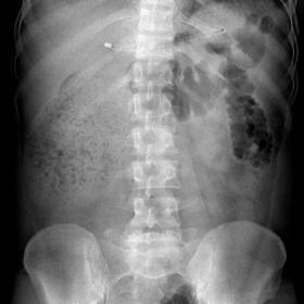 Abdominal radiograph(Erect)- There is an abnormally distended and faecalised bowel loop in the right lumbar region and right 