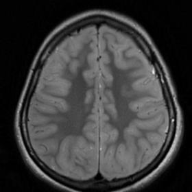 Axial T2 MRI image shows suspicion of mild swelling of the gyri of bilateral cerebral hemispheres with loss of subarachnoid s