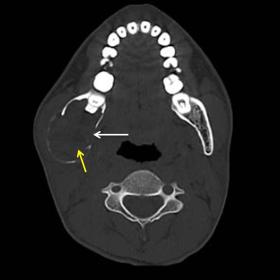 Axial CT image in bone window shows a well-defined, oval, expansile lytic lesion (yellow arrow)involving the left angle of ma