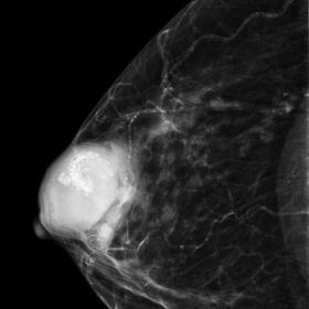 Mammography of the right breast. Right craniocaudal (a) and mediolateral oblique (b) mammograms demonstrated an oval and hete
