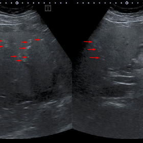 Ultrasound images of the liver show multiple gaseous echogenic foci in the liver (red arrows). This finding raised suspicion 