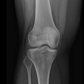 AP radiograph of knee shows shallow femoral notch and hypoplastic tibial spines