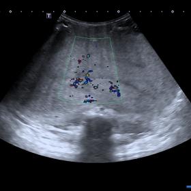 US-Doppler image demonstrating a large vascularised solid hyperechogenic mass occupying most of the abdomen