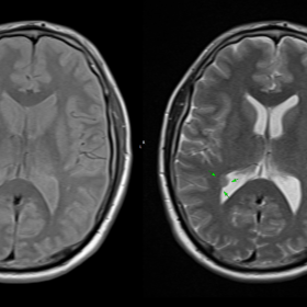 Non-contrast MRI brain axial PD