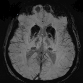 SWI sequence showing calcification within the basal ganglia and thalami bilaterally