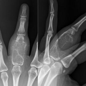 PA and lateral radiographs of the middle finger show an expansile, lytic lesion of the proximal phalanx with internal bony se