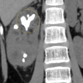 Coronal non-contrast CT image showing right staghorn calculus and few dilated calyces around it (yellow circle)