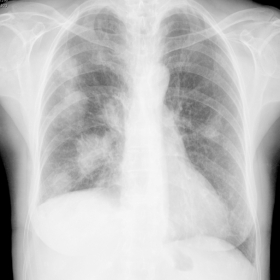 Chest X-ray showing multiple differently sized nodular opacities in both lung fields, which were suspected for metastases