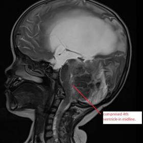On T2 weighted sagittal image, hyperintense central caseation with iso-hyperintense capsule and peripheral hyperintense rim of oedema is seen with hydrocephalus and compression over fourth ventricle outflow tract/foramen of Magendie