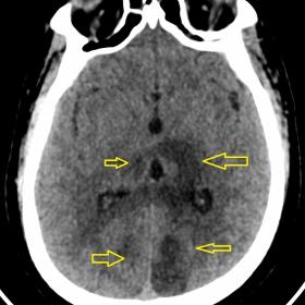 Non-contrast CT scan of the brain shows multiple hypodensities in bilateral thalami, occipital lobes (Figure 1a denoted by yellow arrows), brain stem and bilateral cerebellar hemispheres (Figures 1b and 1c denoted by yellow arrows)