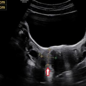 Axial USG image of uterus and adnexa. A well-defined 2.3 x 2.4 cm mass (red arrow) is seen in right adnexa. Wall of the mass 