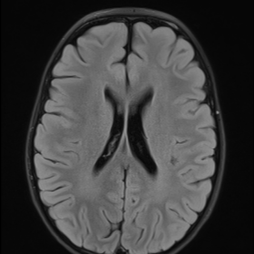 FLAIR axial image at the age of 9 at the level of the lateral ventricles shows very mildly elevated white matter signal of th