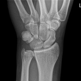 X-ray of the left wrist. On the PA view (a), the lunate has a more triangular shape and the first and second carpal arcs are interrupted. On the lateral view, the lunate is clearly displaced and tilted volarly, creating the typical “spilt teacup” appearance.