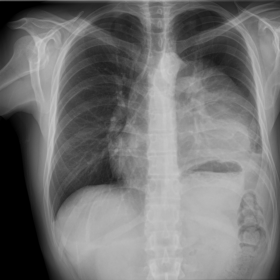 The PA chest radiograph reveals a significant lesion involving the left mediastinum. A positive silhouette is noted with the left upper border of the hearth with preservation of the borders of the left hemidiaphragm, which suggests that the mass does not extend posteriorly. Obtuse angles can be visualized in relation to the lung. There is a discrepancy in lung volume probably due to secondary diaphragmatic paralysis caused by tumour compression. Left hilar point preservation is observed as the mass displace