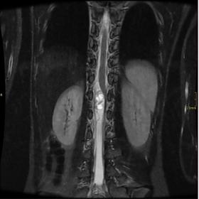Coronal T2-Weighted MRI (Non-Contrast) of Lumbar Spine showing T2 hyperintense intradural oval neoformation posterior to L1-L