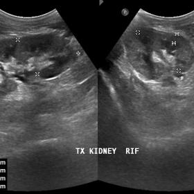 B-mode USG shows normal size and echogenicity of renal parenchyma with preserved cortico-medullary differentiation.