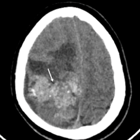 Axial non-contrast CT image – a large heterogeneous hyperdense lesion (white arrow) is seen in right cerebral hemisphere with internal specks of calcification and surrounding oedema.