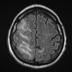 Two-day follow-up axial FLAIR MRI image of the brain shows cortical oedema of the right frontal and parietal lobes with adjac