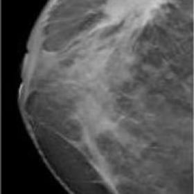 2D mammography and DBT: Irregular, spiculated masses in the upper outer and central quadrant of the right breast and lower in