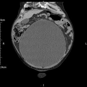 Select coronal CT with contrast slice of abdomen and pelvis revealing grossly distended bladder measuring 21.3cm x 26.8cm x 3