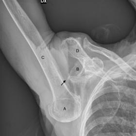 Case 1: anteroposterior (AP) shoulder radiograph showing inferior displacement of right humeral head (A) below the glenoid fo