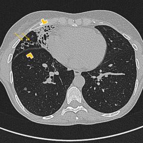 In this slice, middle lobe volume loss is depicted (arrowheads), almost completely replaced by cystic-like images (arrows) wh
