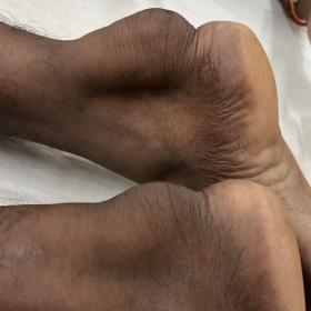 Swelling of the posterior aspect of both ankles at the level of Achilles tendon insertion.