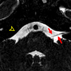 Axial CISS MR image at the pons showing absence of bilateral vestibulocochlear nerves and right facial nerve (arrowhead) with an isolated left facial nerve (red arrow); high signal intensity is observed in the right mastoid region, probably secondary to inflammatory process.