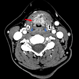 Axial contrast-enhanced image of the first CT scan, demonstrating an avidly enhancing and ill-defined lesion with irregular margins (arrow) extending from the anterior commissure of the larynx, infiltrating into the preepiglottic and paraglottic spaces (arrowheads) bilaterally and into both false vocal cords. Diffuse swelling of the strap muscles was associated (*).