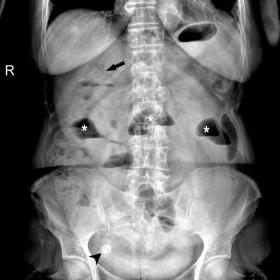 PA erect abdominal x-ray showing small bowel distension with air-fluid levels (white asterisks), secondary to distal ileum obstruction caused by a biliary stone (black arrowhead). Subtle pneumobilia is also observed (black arrow).