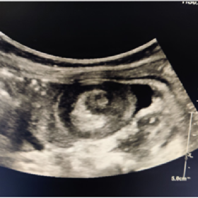 Ultrasound abdomen shows telescoping of small bowel loops into one another (target sign) in left lumbar region.